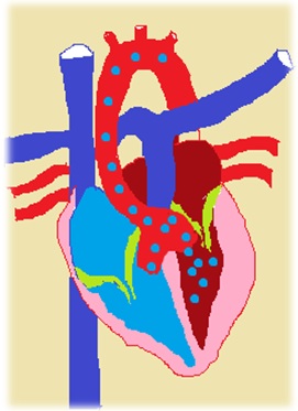 Overriding aorta